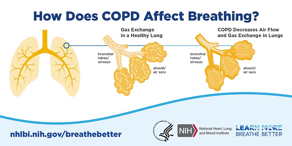 Managing the Price of Bronchial asthma and COPD Inhalers