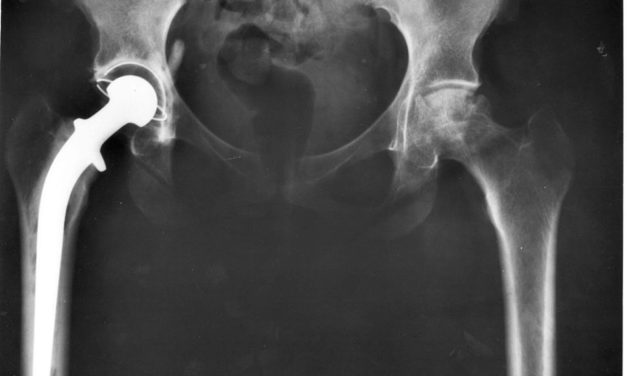 The Facts about Hip Replacement