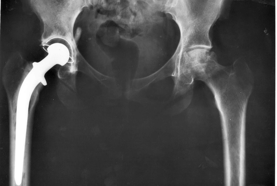 The Facts about Hip Replacement